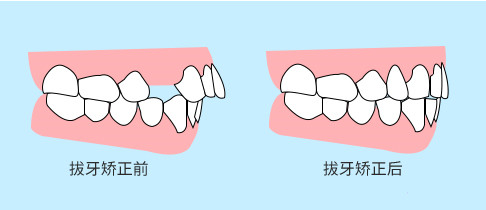 牙齿矫正前后对比图